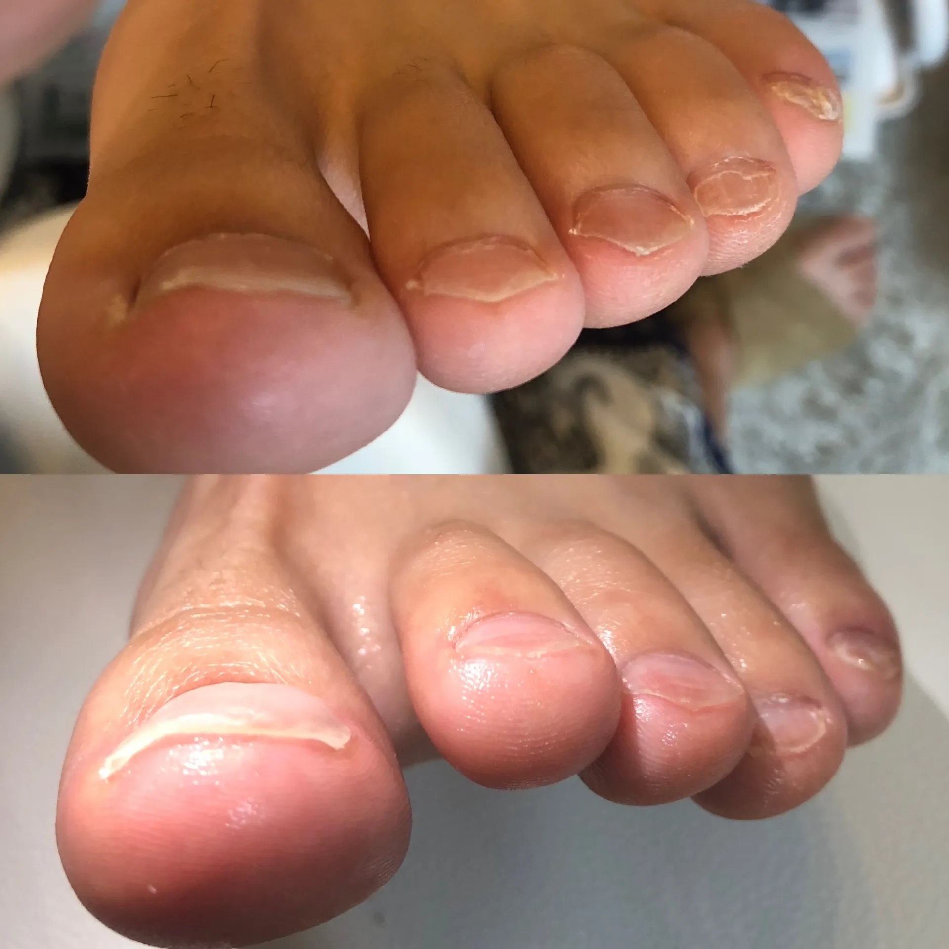 陥入爪突き刺さる痛みありませんか？