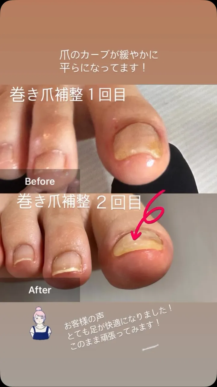 巻き爪補整